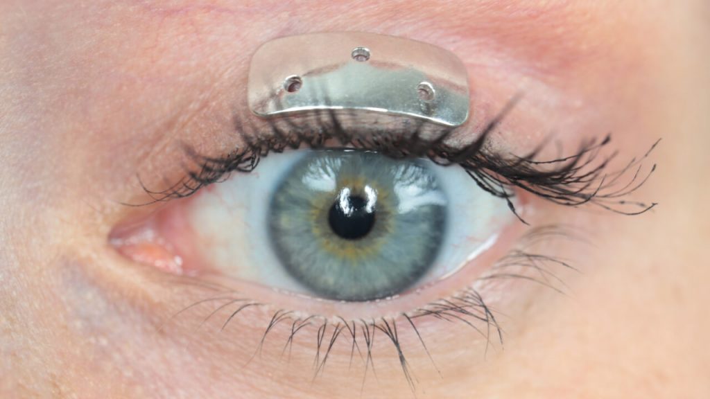 Oculid Platinum implant