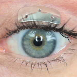 Oculid Platinum implant