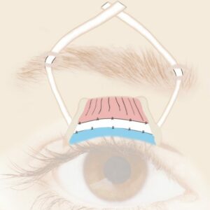Ptose-up®